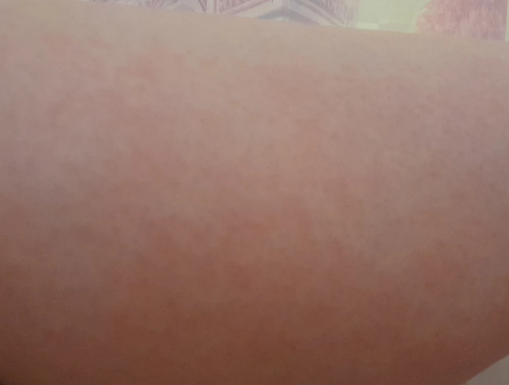 Вызывают аллергию